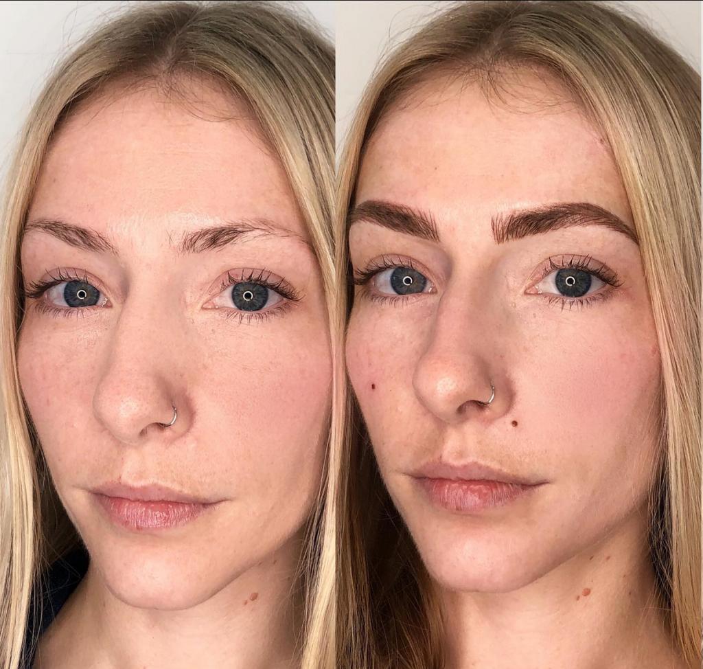 Susanne Piet | Achieve a Timeless Natural Beauty Mark with Safe, Long-Lasting Methods