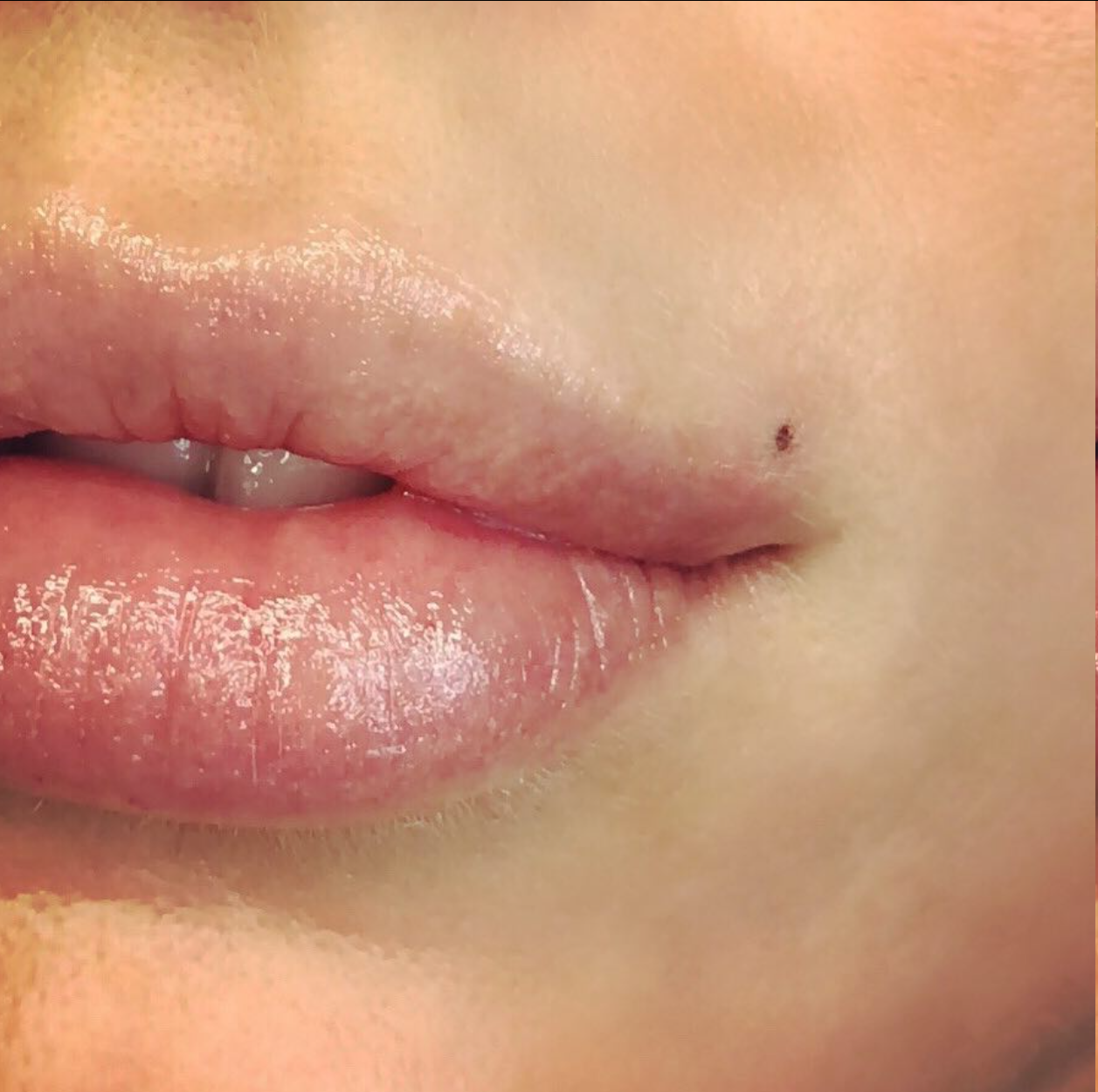 Close-up of lips with glossy balm and a small mole on the skin