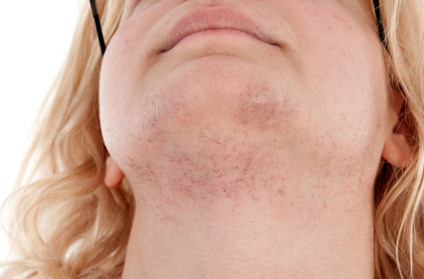 Close-up of a woman's chin showing acne and scars